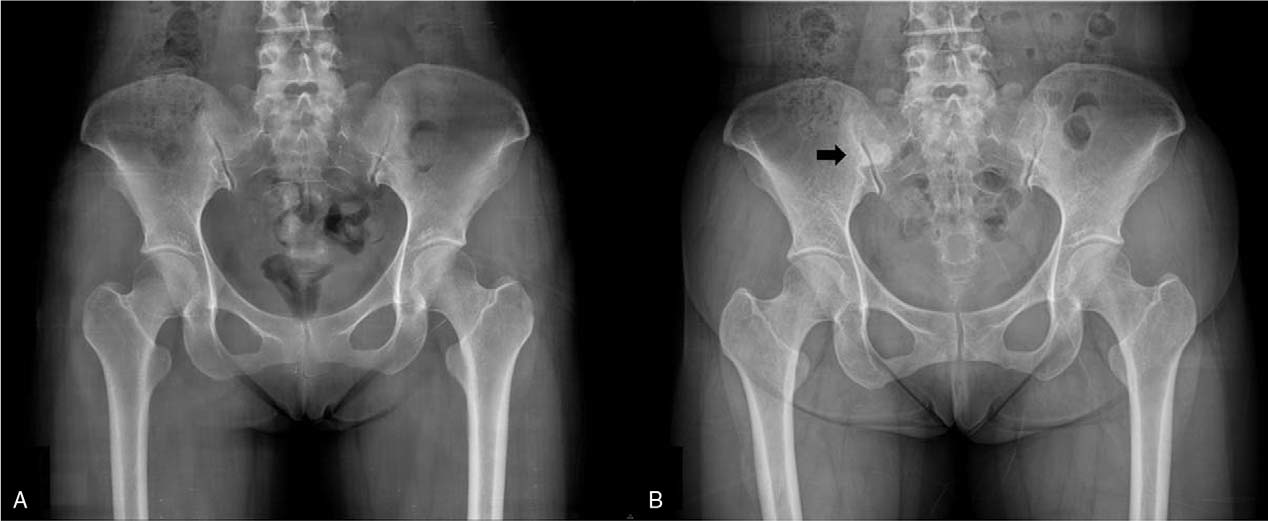 Dieta radioterapia pelvis